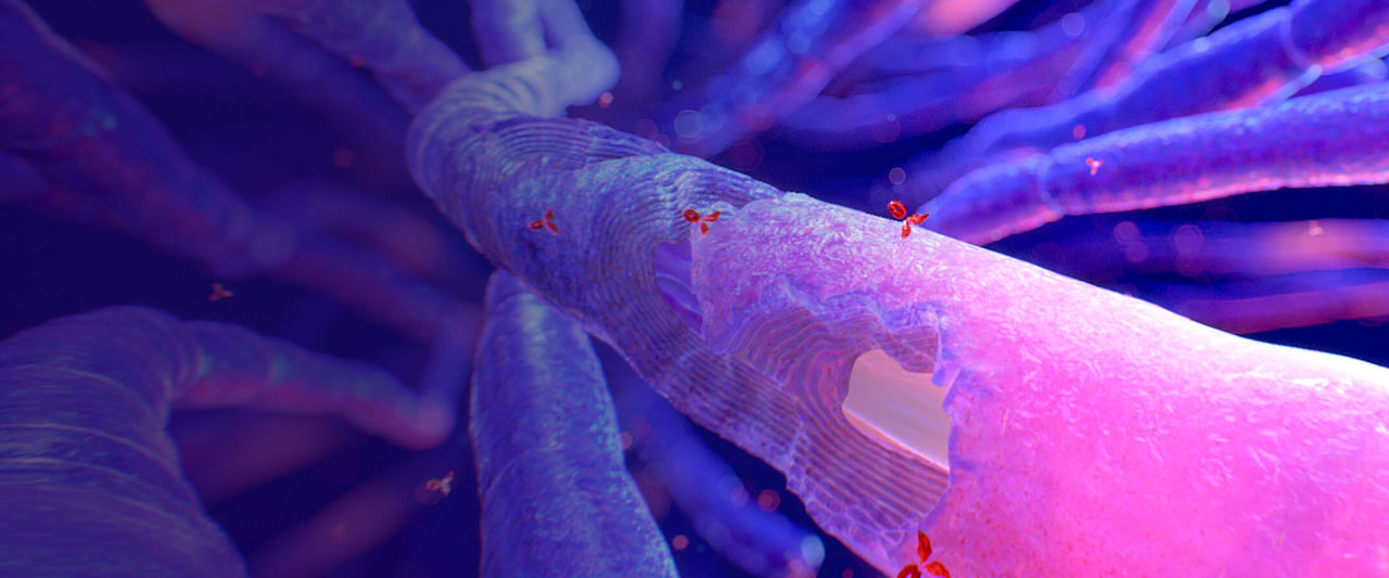 Illustration of a microscopic view of a nerve with damaged myelin sheath